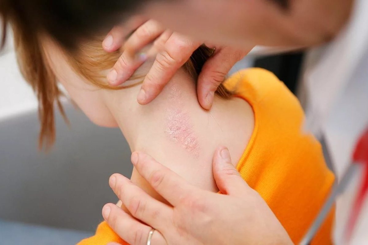 Psorias müalicəsi Bakıda | Effektiv və Təcrübəli Dermatoloq