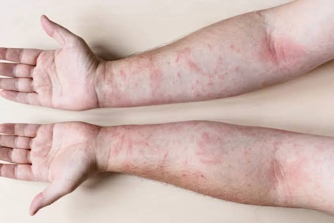 Kontakt dermatiti: Hansı maddələr allergik dəri reaksiyasına səbəb ola bilər?