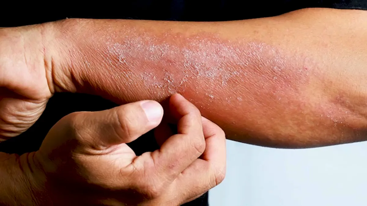 Dermatitis Herpetiformis: Səbəbləri, Əlamətləri, Diaqnostikası və Müalicəsi