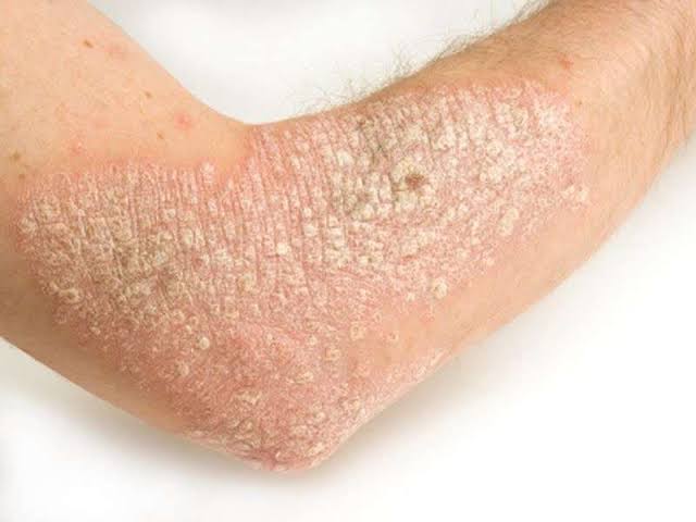Psoriazın Kəskinləşmə Səbəbləri: Simptomları Necə İzləmək və Qarşısını Almaq Olar