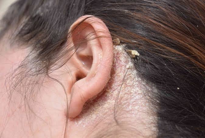 Seboreik dermatit: Kəpək və baş dərisində qaşınmanın səbəbləri